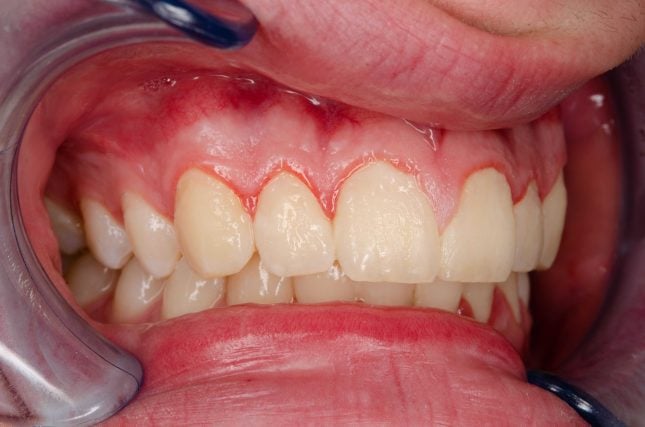 Teeth showing early demineralization signs