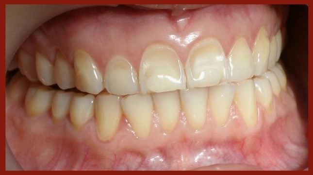 Teeth with visible plaque discoloration.