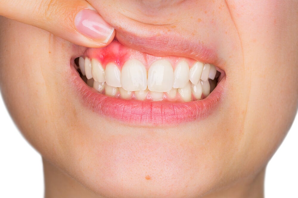gums showing early signs of periodontis
