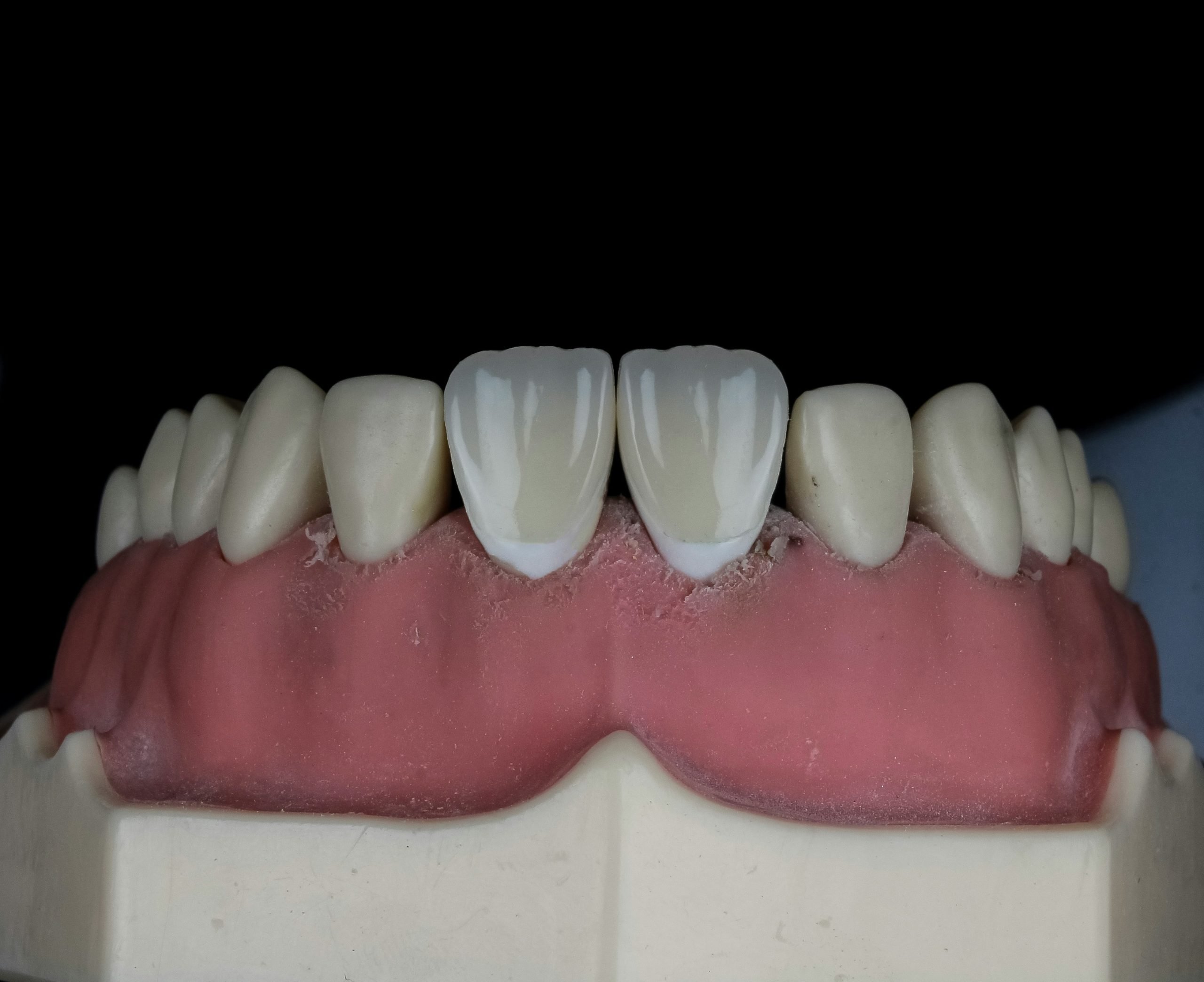 Teeth Remineralization example