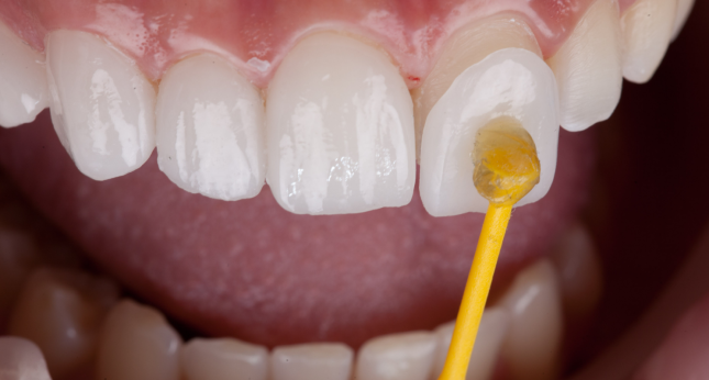 Close-up of a ceramic dental veneer being bonded to the tooth surface